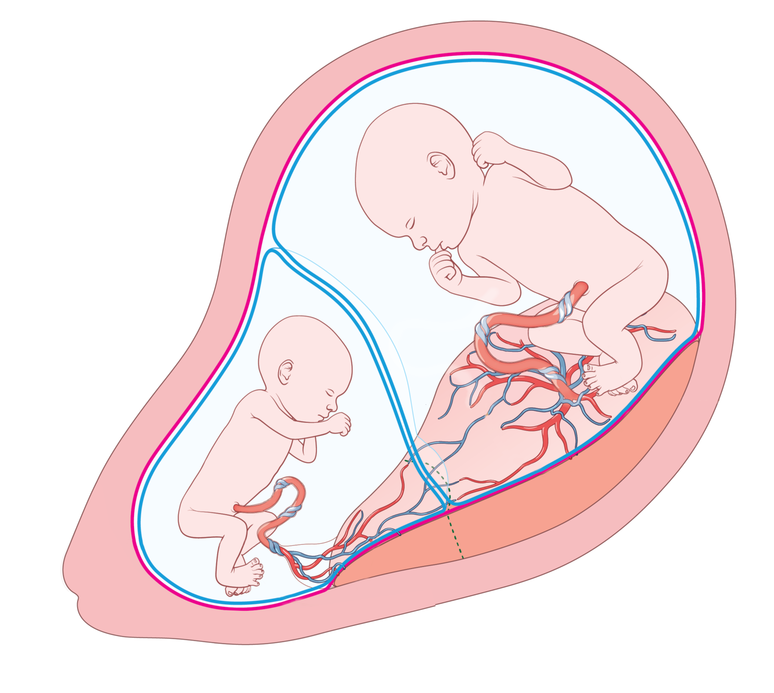 Information for families - Sunnybrook Twins Research Centre